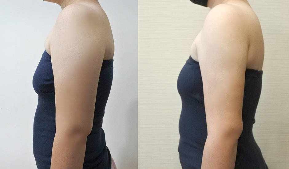 雷射減脂 手臂,贅肉,瘦手臂